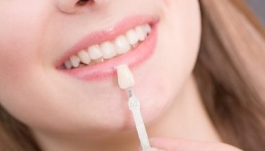 Porcelain Veneers - restorative dental adelaide