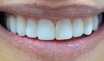 Dental smile lift gallery. Restorative dentist Adelaide
