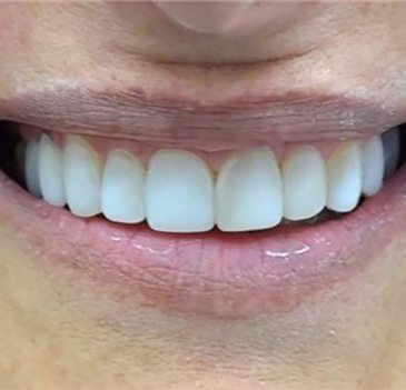 Dental smile lift gallery. Restorative dentist Adelaide